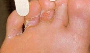 Lesiones de dermaid por reventa desde los pies