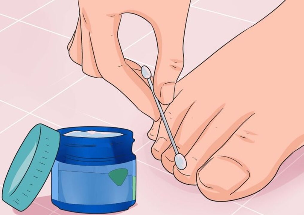 Cure el hongo de las uñas