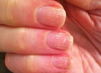 La etapa temprana del hongo en las uñas