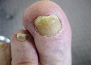 Las causas de la aparición del hongo en las uñas