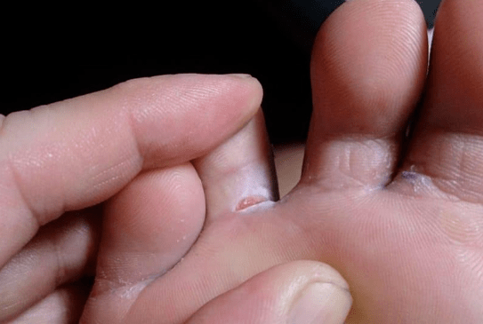 La aparición de formaciones de burbujas en los pies