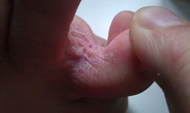 Etapas de desarrollo de hongos entre los dedos de los pies