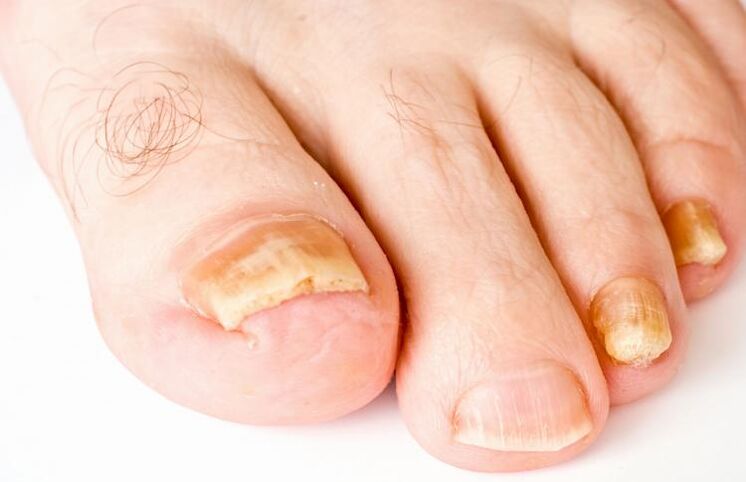 uñas amarillas debido a hongos