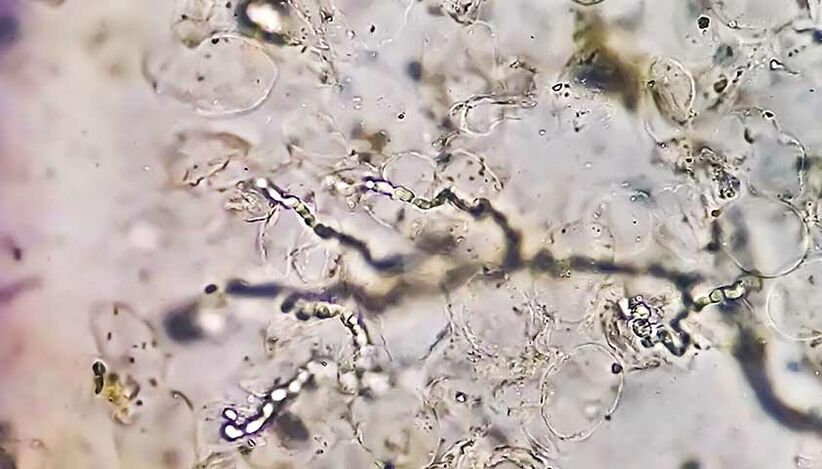 Hongos bajo el microscopio los culpables del desarrollo de la micosis del pie